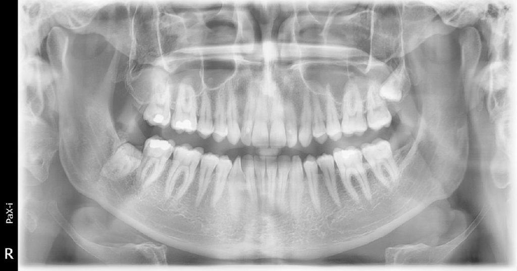 OPG přehledný snímek je součástí zubního vyšetření